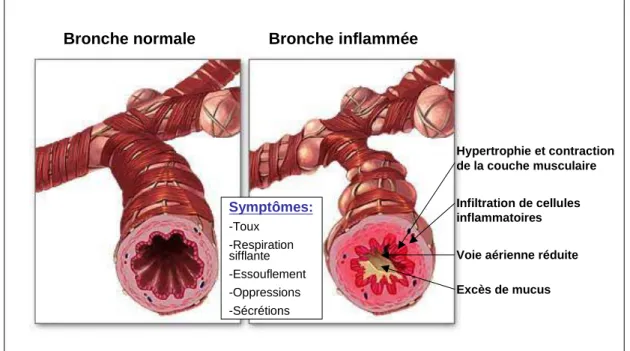 Figure  2 :  Représentation  de  l’état  des  bronches  et  symptômes  observés  chez  un  sujet  asthmatique