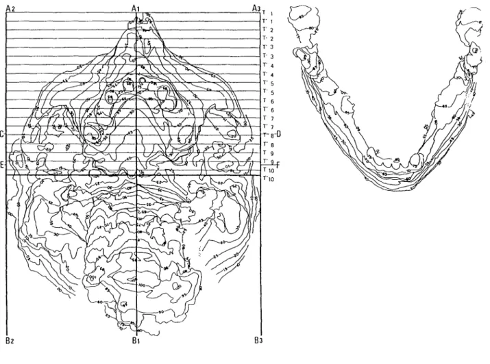 Figure 11 : Traces stéréogrammétriques ( post crémation)