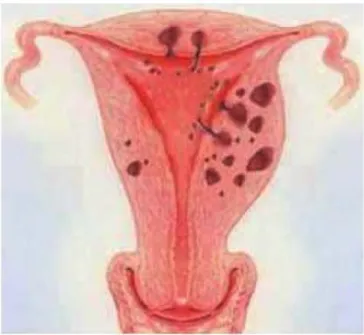 Figure 1. Schéma de l’utérus : invasion du myomètre par les glandes endométriales  (3) 