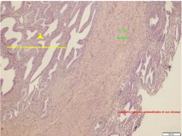 Figure 3. Adénomyose utérine en microscopie optique, grossissement x5 (CHU  Nancy) 