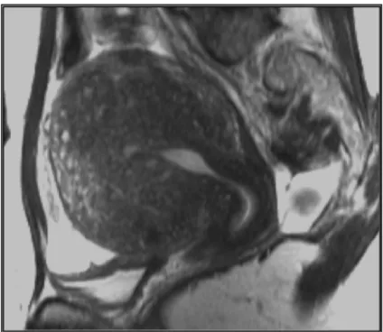 Figure 6. Adénomyose antérieure en IRM avec utérus globuleux, adénomyose  pseudo tumorale, épaississement du mur antérieur, kystes anéchogènes, myomètre 