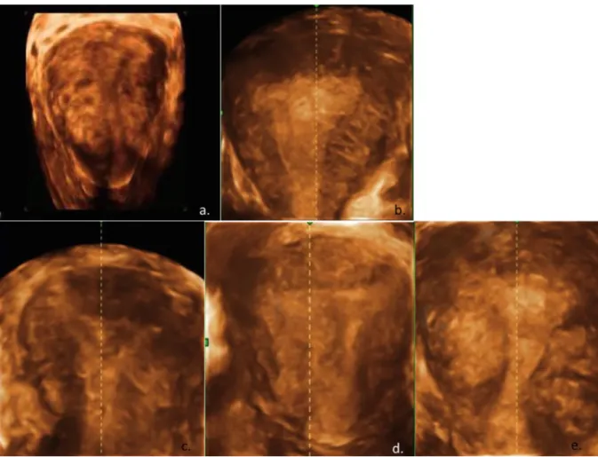 Figure 9. Illustrations des signes d’adénomyose en échographie 3D 