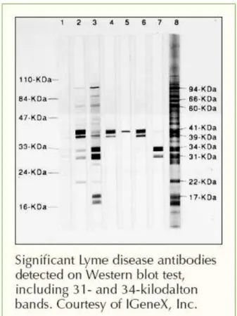 Figure 4 : Exemple de résultat positif obtenu par le test diagnostic du Western blot sur la  borréliose de Lyme