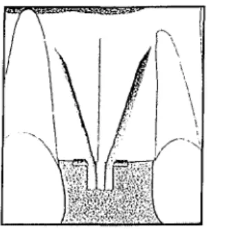 fig. 8 :Anatomie d'une lame de LINKOW [10]