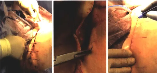 Figure 1.2:  Current wound  closing  procedure. Left: Gross  alignment stitches  are placed  in the fascia  layer