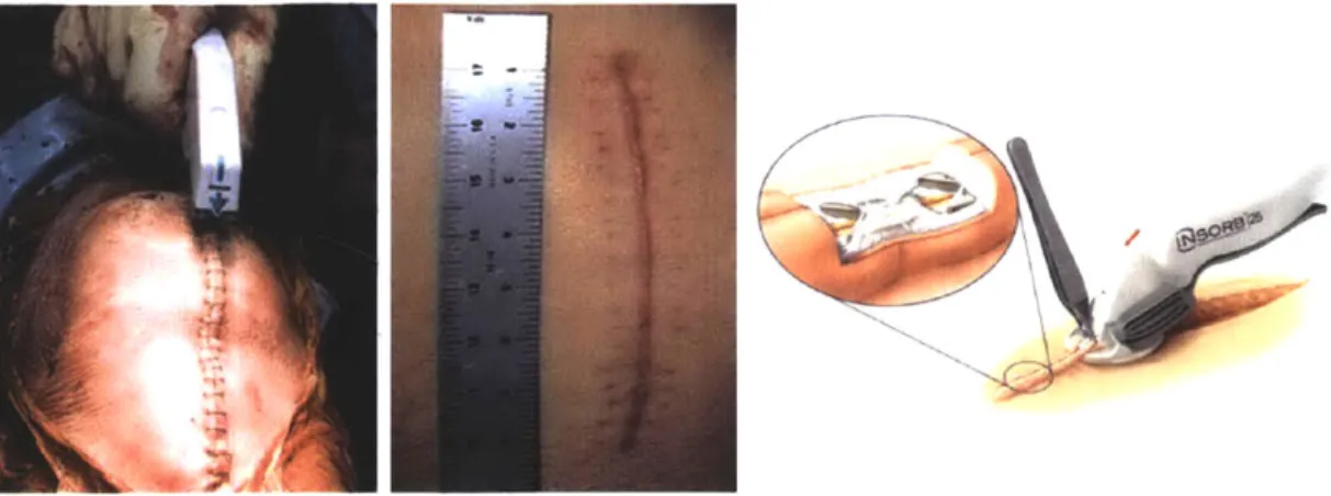 Figure 1.3:  Past devices  that tried to  solve  the  skin closure  problem. Left:  Disposable surgical  staplers  are fast but can  only  be  used on  certain parts of  the body