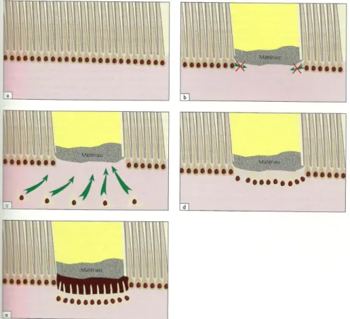 Figure 3 : Schéma de la dentinogenèse réparatrice induite par coiffage pulpaire direct