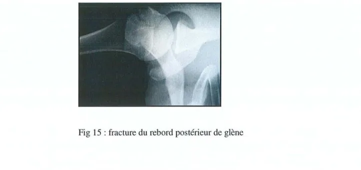 Fig 15 : fracture du rebord postérieur de glène