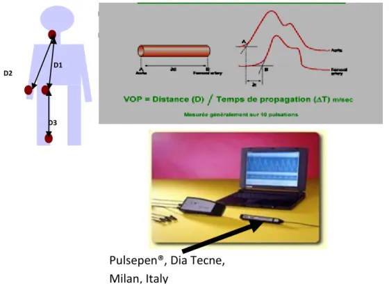 Figure 4 : Méthode de mesure de la VOP par tonométrie d’aplanation  