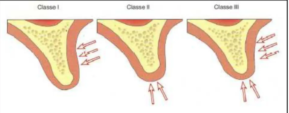 fig 11. Classification des défauts osseux selon Seibert (PALACCI, 2001) 