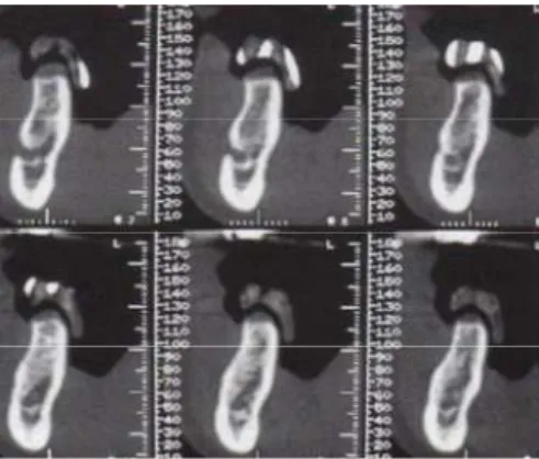 fig 17. Reconstruction 2D par logiciel Dentascan (CAVEZIAN, 2006) 