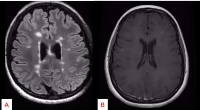 Figure  2 :  IRM  cérébrale (A :  séquence  T2  flair ;  B :  séquence  T1  avec  injection  de  gadolinium) :  multiples lésions en hypersignal T2, et deux lésions se rehaussant après injection de gadolinium 