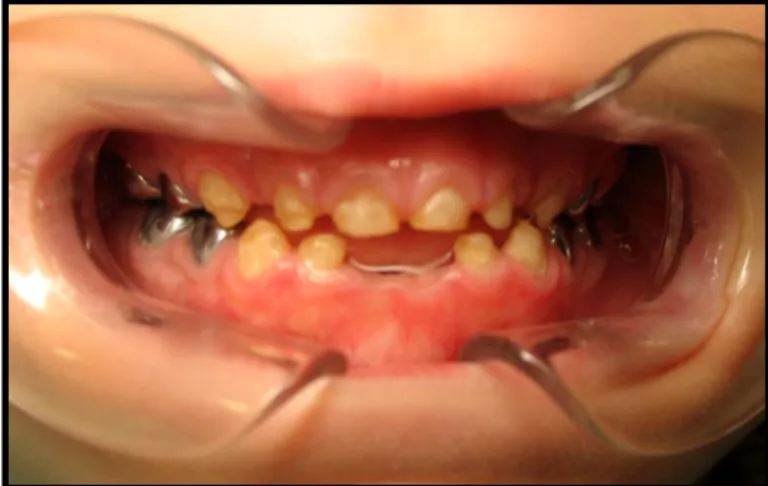 Figure 12 : Amélogenèse imparfaite des dents temporaires. Coiffes pédiatriques mises en  place pour préserver les molaires