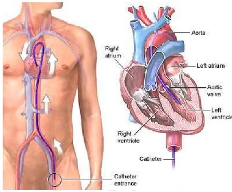 Figure 2. Diagram of current percutaneous procedure2