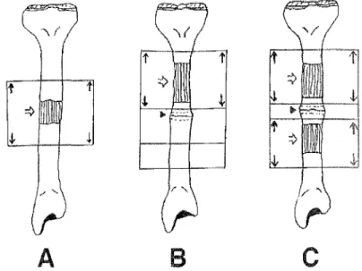 Fig. 14 : Les différents modes de distraction osseuse selon (ILIZAROV, 1,27-29, 58) A : distraction monofocale B : distraction bifocale C : distraction trifocale