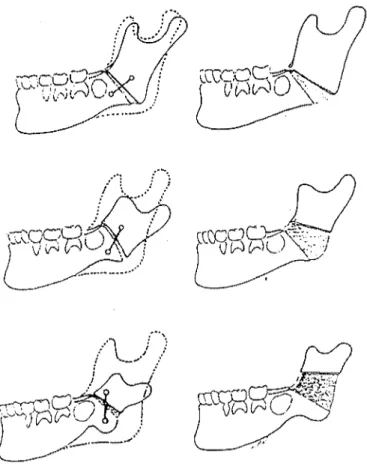 Fig. 25 : Localisation de la corticotomie et des fiches osseuses en fonction du vecteur de distraction désiré (ORTIZ-MONASTERIO, 45).