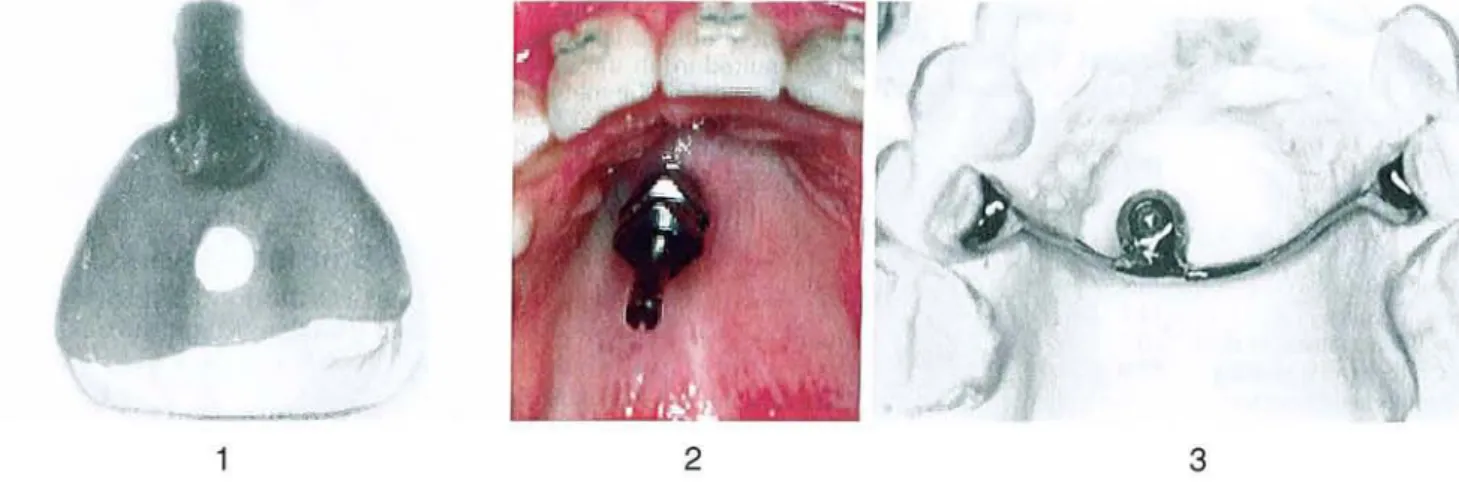 Figure 5 : Ajustement de l'arc transpalatin en technique standard.