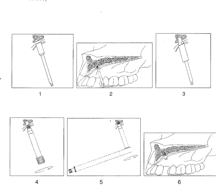 Figure 7 : Démarche chirurgicale de l'Orthosystem (Société Straumann).