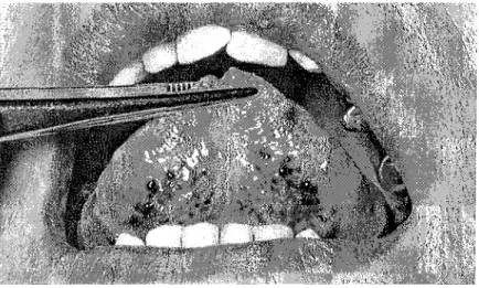 Figure 3a - Varices de la face inférieure de la langue chez une patiente de 64 ans. (92)