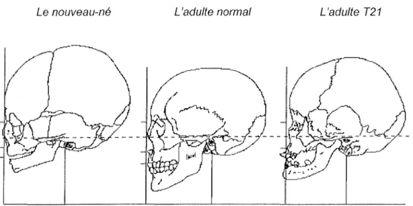 Figure 4 : Variations ostéocrâniennes entre l'adulte normal et l'adulte T21 (RIVERBEND, 2003)