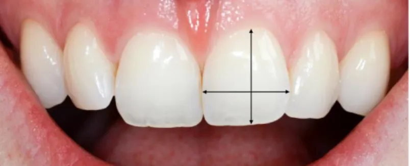 Figure 15 : Incisives centrales maxillaires de Mme N. dont le rapport largeur/longueur est  d’environ 80%, valeur considérée comme « idéale » (source : document personnel)