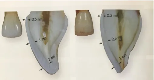Figure 24 : Coupe longitudinale de deux incisives centrales maxillaires illustrant les  épaisseurs des tissus dentaires