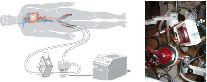 Figure 3: Circuit d’ECMO VA. Le sang veineux est drainé grâce à une pompe dan s un  oxygénateur puis réinjecté au niveau artériel