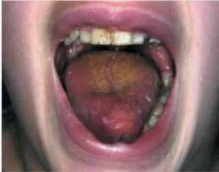 Figure 7: Présence d’une salive mousseuse et glutineuse recouvrant la langue et les incisives  (34)