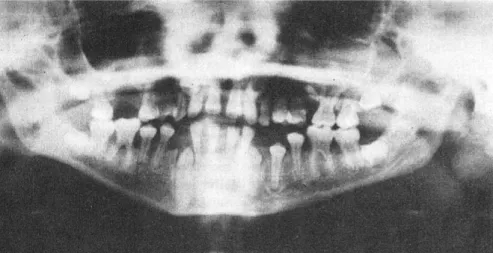 Figure 8: Perte osseuse horizontale généralisée chez une jeune PW de 12 ans  (46). 