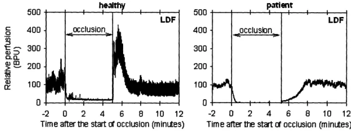 Figure 3.6 Representative  LDF  measurement during test of Post-Occlusive  Reactive  Hyperemia  (PORH):
