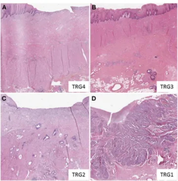 Figure 3. Exemple de régression tumorale selon la classification de Dworak. (A) TRG4 régression complète