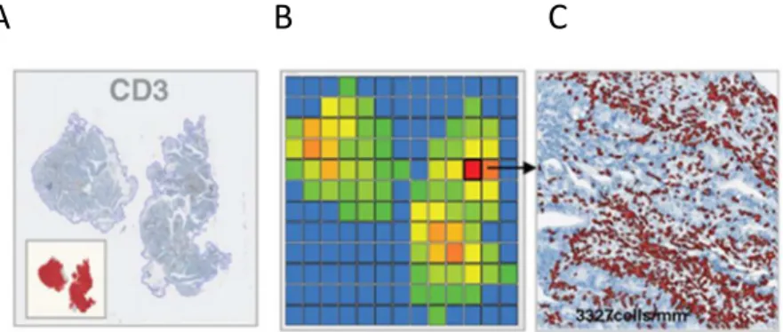Figure  9.  Exemple  d’analyse  d’une  biopsie  par  le  logiciel  d’image  Definiens