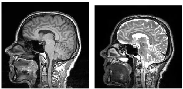 Figure 1.15  Image IRM pondérée en T 1 à gauche et en T 2 à droite, coupe sagittale.