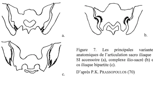 Figure  7.  Les  principales  variantes  anatomiques  de l'articulation  sacro iliaque  :  SI accessoire (a),  complexe ilio-sacré (b)  et  os iliaque bipartite (c)