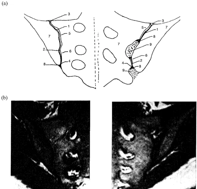Figure 8. Coupe frontale schématique des articulations sacro-iliaques et illustration en  IRM 