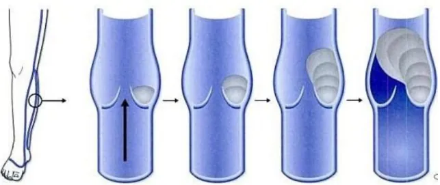Figure 6 : Développement des thrombis au niveau des sacs valvulaires des veines du  membre inférieur [17] 