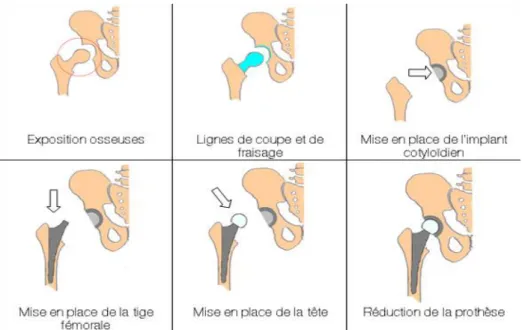 Figure 8 : Illustration destinée au patient qui explique de façon simple et accessible les  différentes étapes d’une arthroplastie pour PTH [41] 