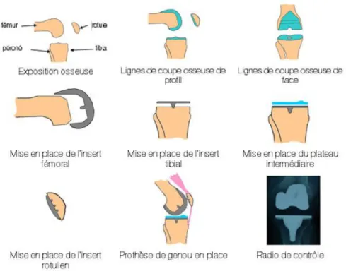 Figure 9 : Illustration destinée au patient qui explique de façon simple et accessible les  différentes étapes d’une arthroplastie pour PTG [42] 