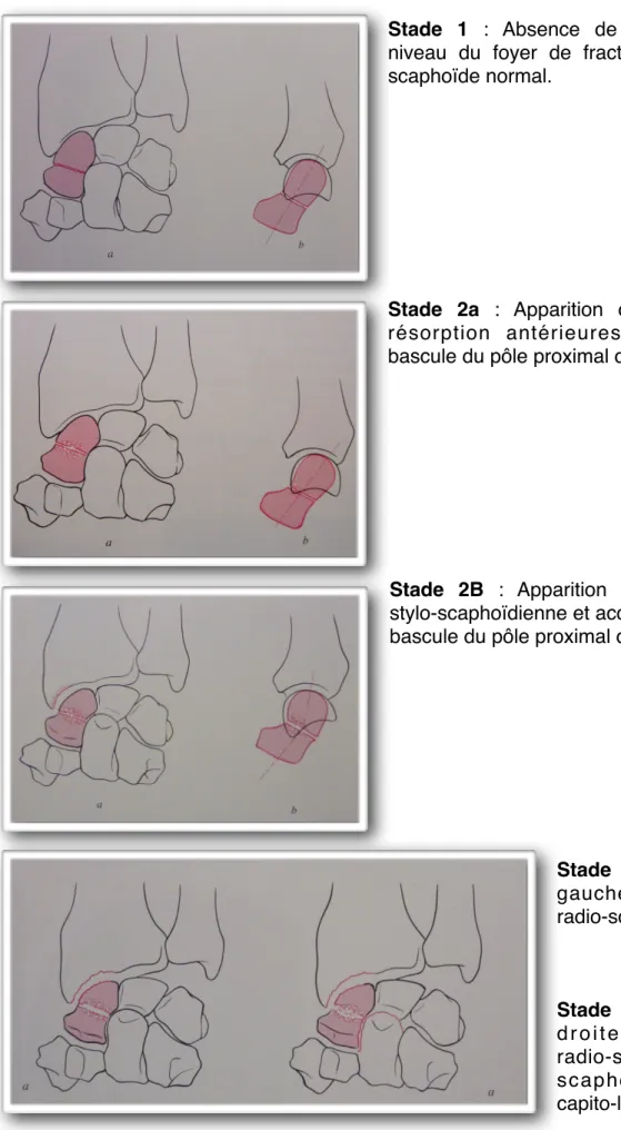 Figure 1 : Evolution des fractures du scaphoïde de la pseudarthrose vers l’arthrose du poignet  selon la classification d’Alnot [12], [13]