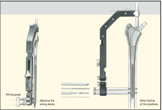 Figure 2: ancillaire pour le verrouillage distal.