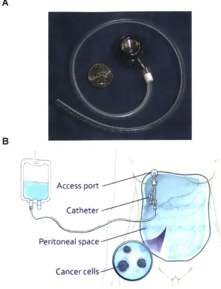 Figure  1.2.  Port-catheter system  used  to  deliver  IP therapy.  (A)  Example  of an  FDA-approved  port- port-catheter  system  for  IP therapy