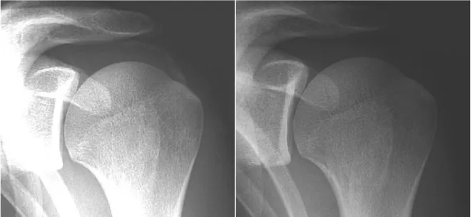 Figure 5 : Evolution naturelle d’une tendinite calcifiante avec évacuation calcique dans la  bourse séreuse chez un patient en crise hyperalgique
