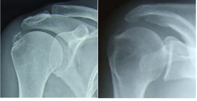 Figure 10 : Exemple de calcification de type  C (selon Molé et al.)  