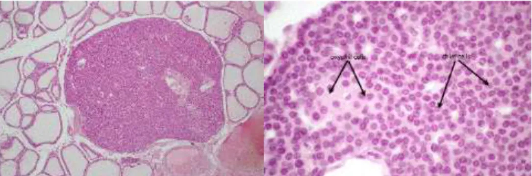 Figure 8 : A gauche : parathyroïde normale intrathyroïdienne. A droite: cellules oxyphiles et cellules  principales