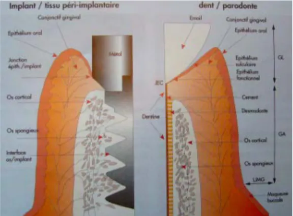 Figure 1 :Comparatif entre la gencive péri dentaire et la muqueuse péri implantaire  GL :Gencive Libre ; GA : Gencive Attachée 
