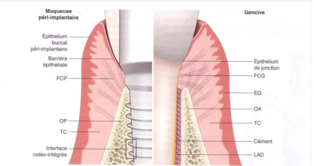 Figure 2 : Principales différences entre le modèle parodontal et le modèle péri- péri-implantaire 