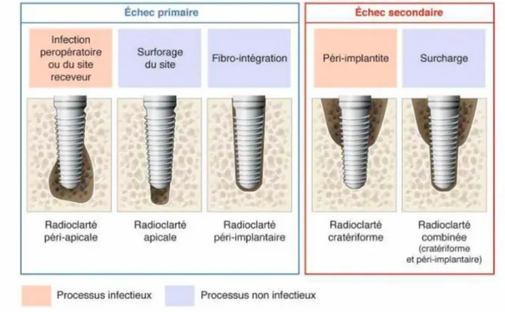 Figure 7 : interprétation radiographique des échecs implantaires  (Source : Parodontologie et dentisterie implantaire, P