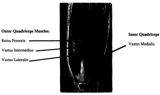 Figure 5: The Outer  Quadriceps  Muscles:  Retus Femoris,  Vastus  Intermedius, Vastus  Lateralis and the Inner Quadriceps  Muscle:  Vastus Medialis  muscle [11]