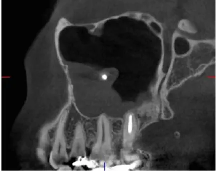 Figure 3 : truffe aspergillaire, scanner 3D (54) 