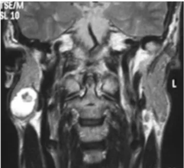 Figure 10 : Cystadenolymphome papillaire vue par une IRM coronale T1 (85) 